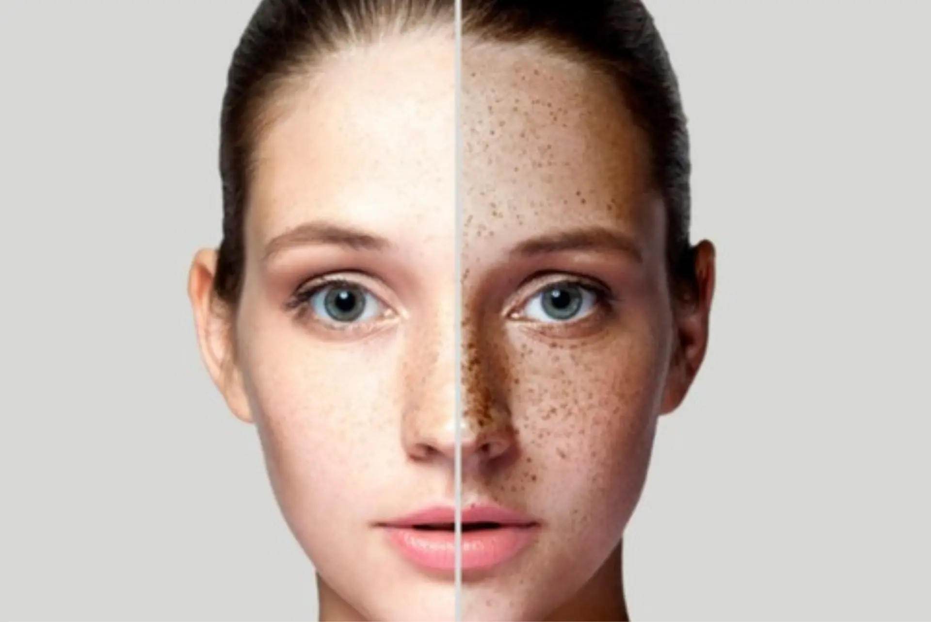 barelaser medspa photofacial